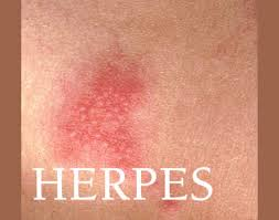 Illustration for article titled Obat Penyakit Herpes